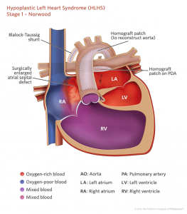 Zespół hipoplazji lewego serca - HLHS