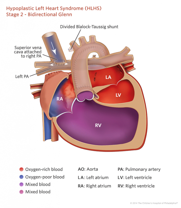 Zespół hipoplazji lewego serca - HLHS - Klinika Kardiochirurgii ...