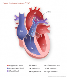 patent ductus arteriosus